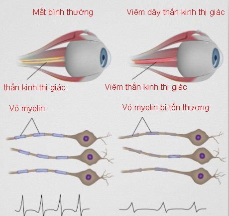 Ảnh 1 của Viêm dây thần kinh thị giác